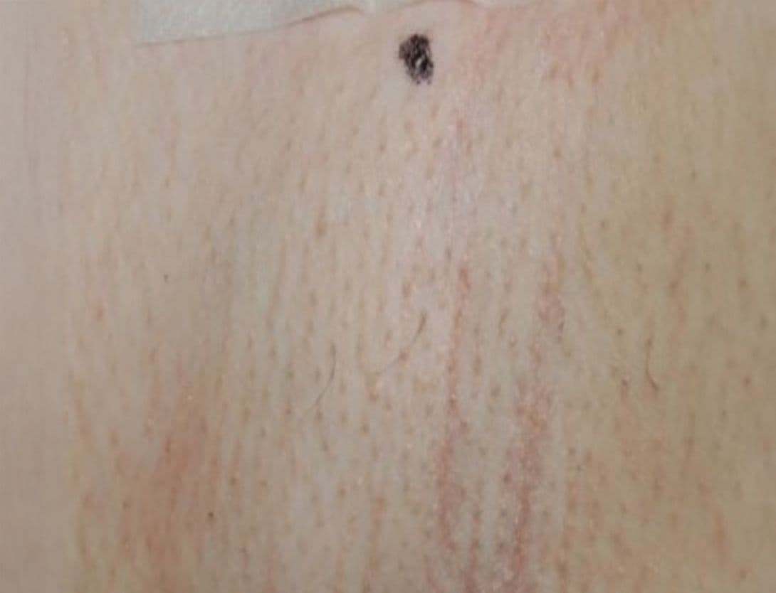 close up image of skin with hair removed from laser