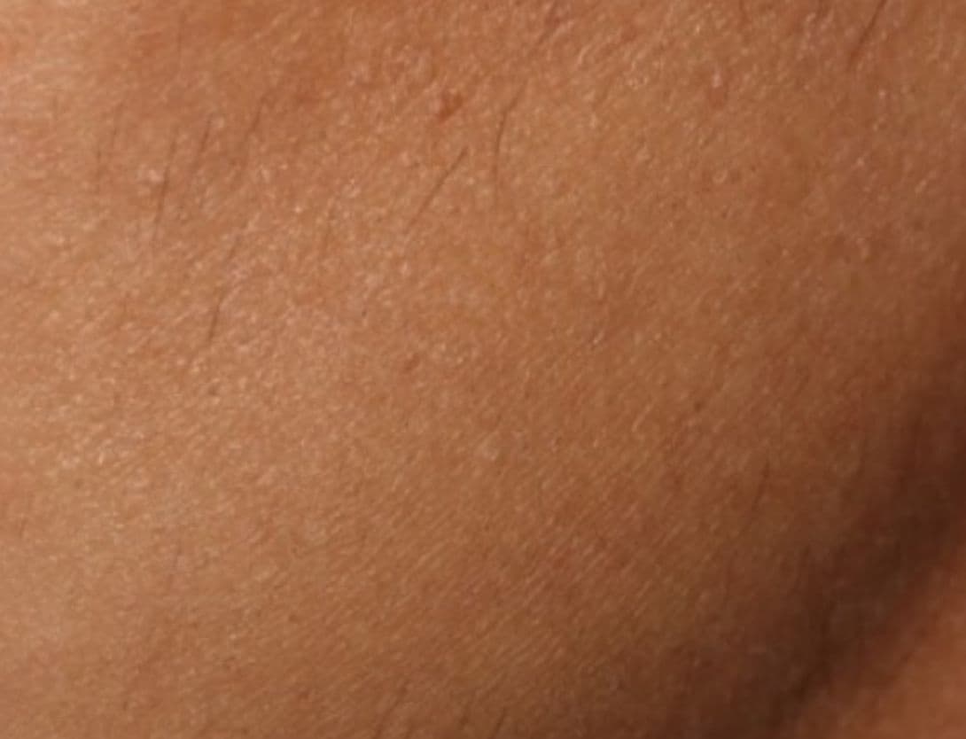 Close up of skin after hair laser removal