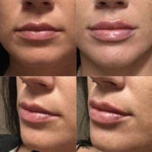 juvederm-revivemd-300x300.jpg