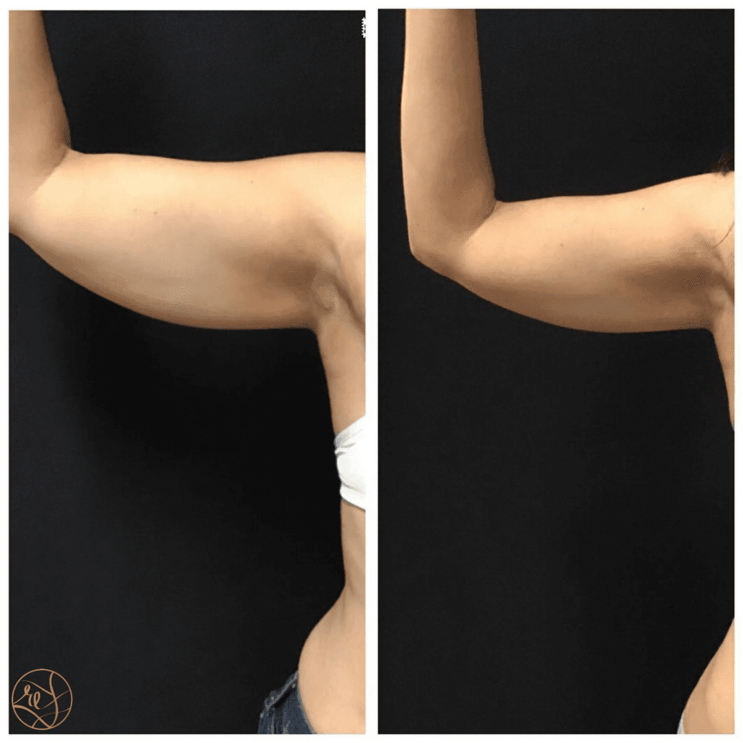 ArmCoolSculptingB&A.png