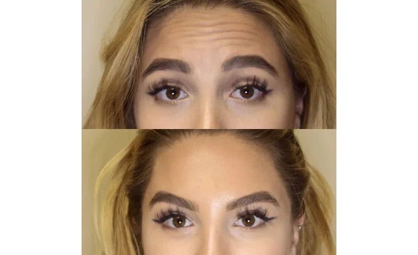 Botox-Before-and-after-revive-med-spa-1.jpg