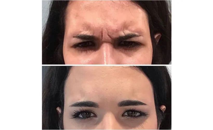 Botox-Before-and-after-revive-med-spa-2.jpg