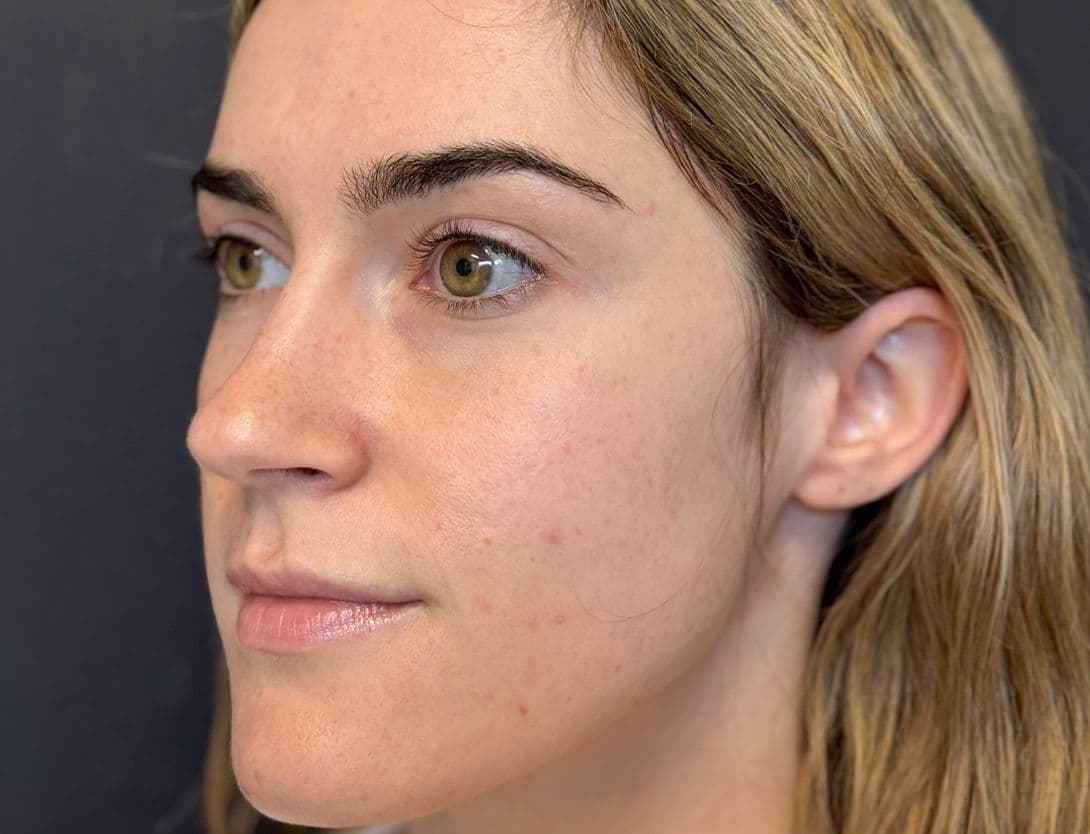 woman's face before microneedling treatment