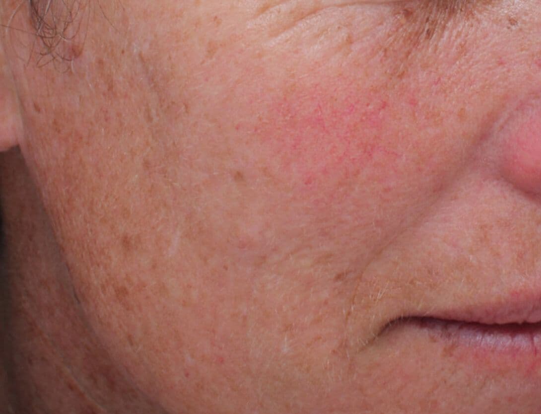 Laser-Resurfacing-2-After.jpg