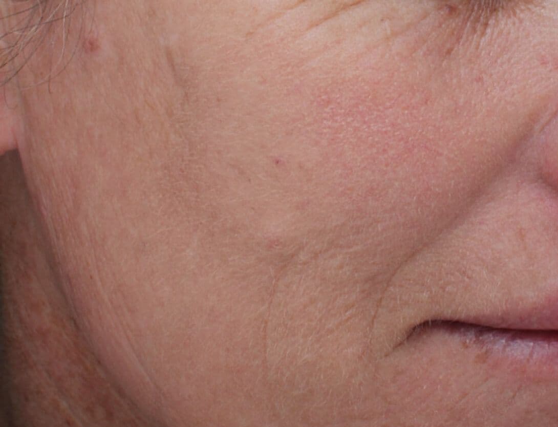 Laser-Resurfacing-2-Before.jpg