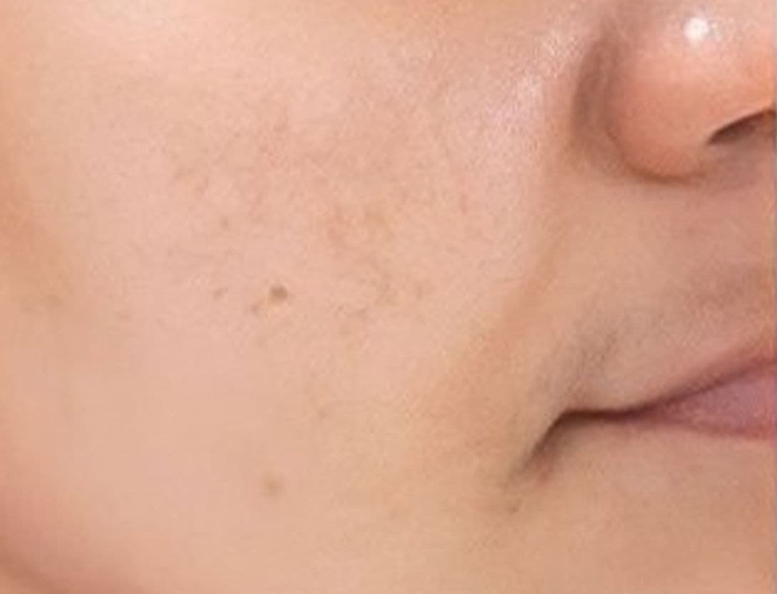 Close up image of woman's skin after mesotherapy with hyperpigmentation issues resolved