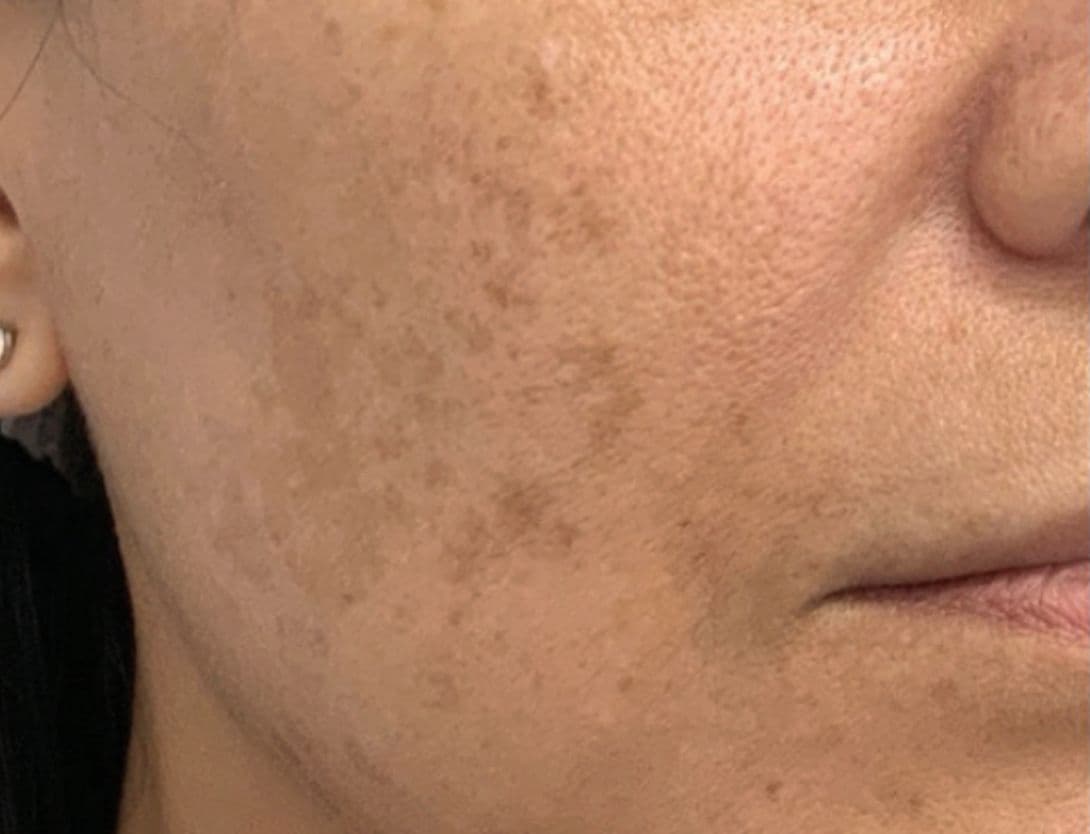 close up of woman's face before mesotherapy treatment with hyperpigmentation