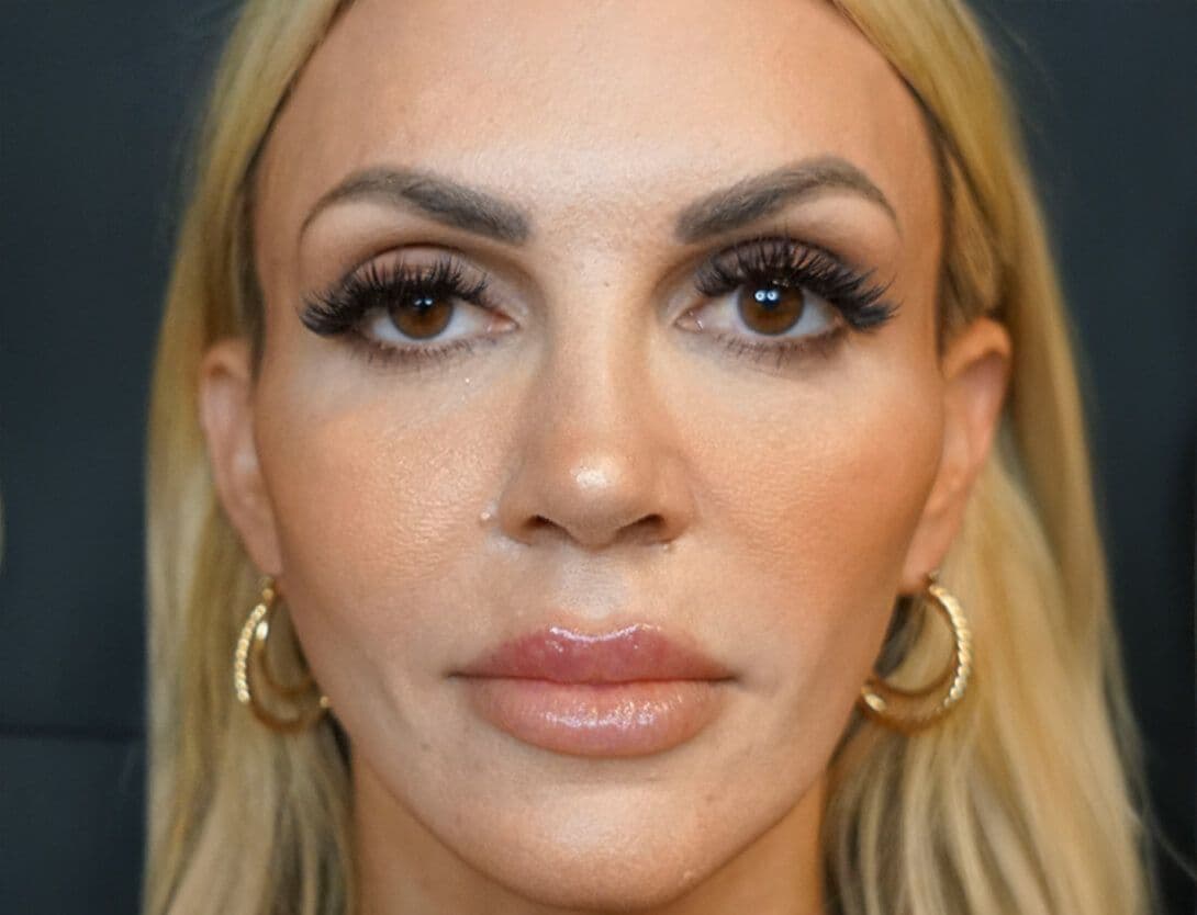 ashley_king_ba_sculptra