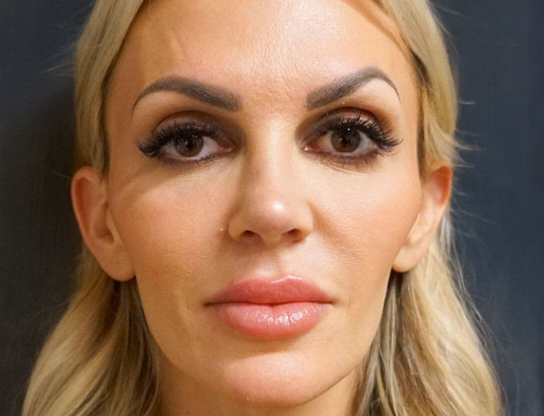 ashley_king_ba_sculptra