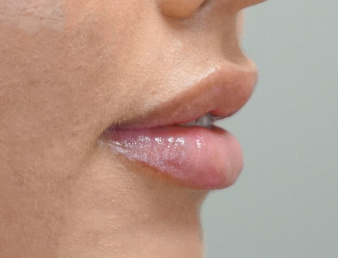 brenna_lip_filler_flip_side_After.jpg