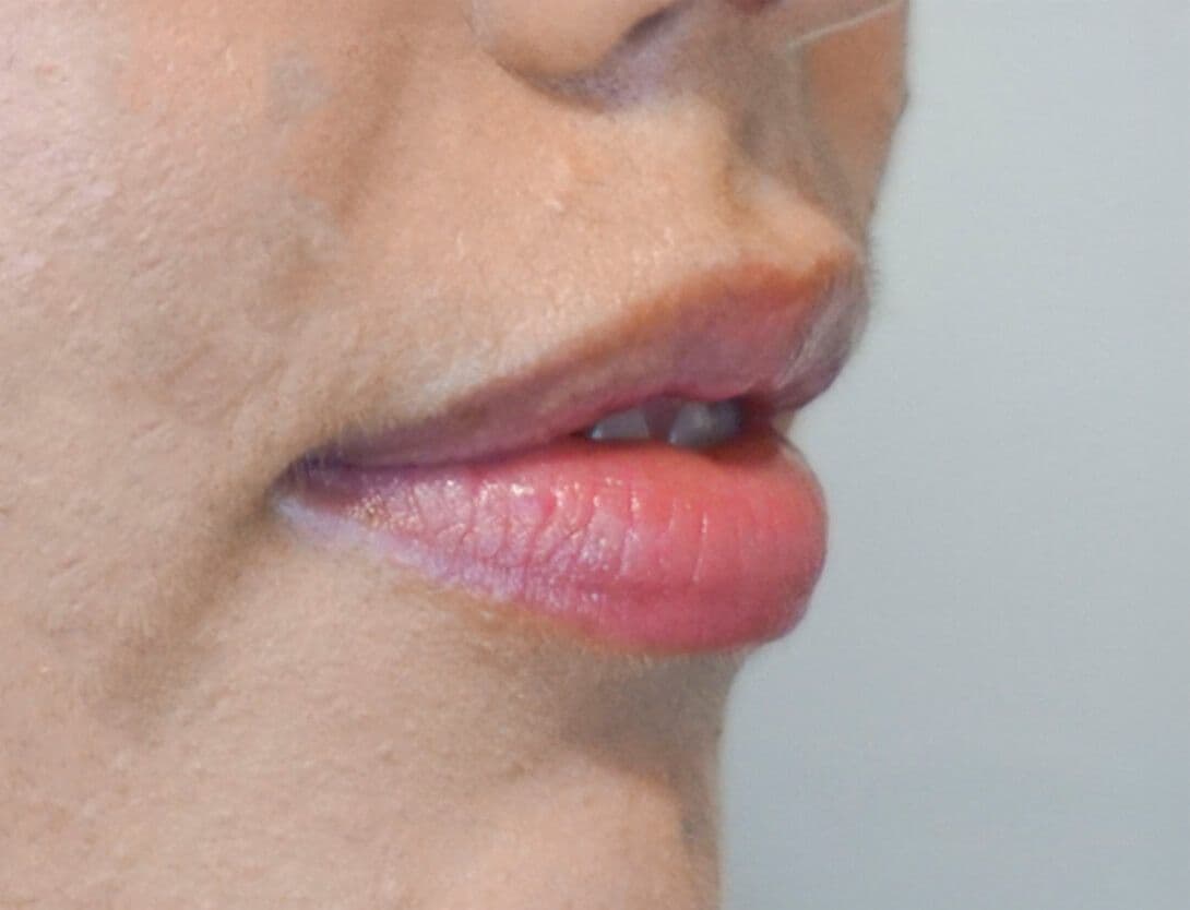 brenna_lip_filler_flip_side_Before.jpg