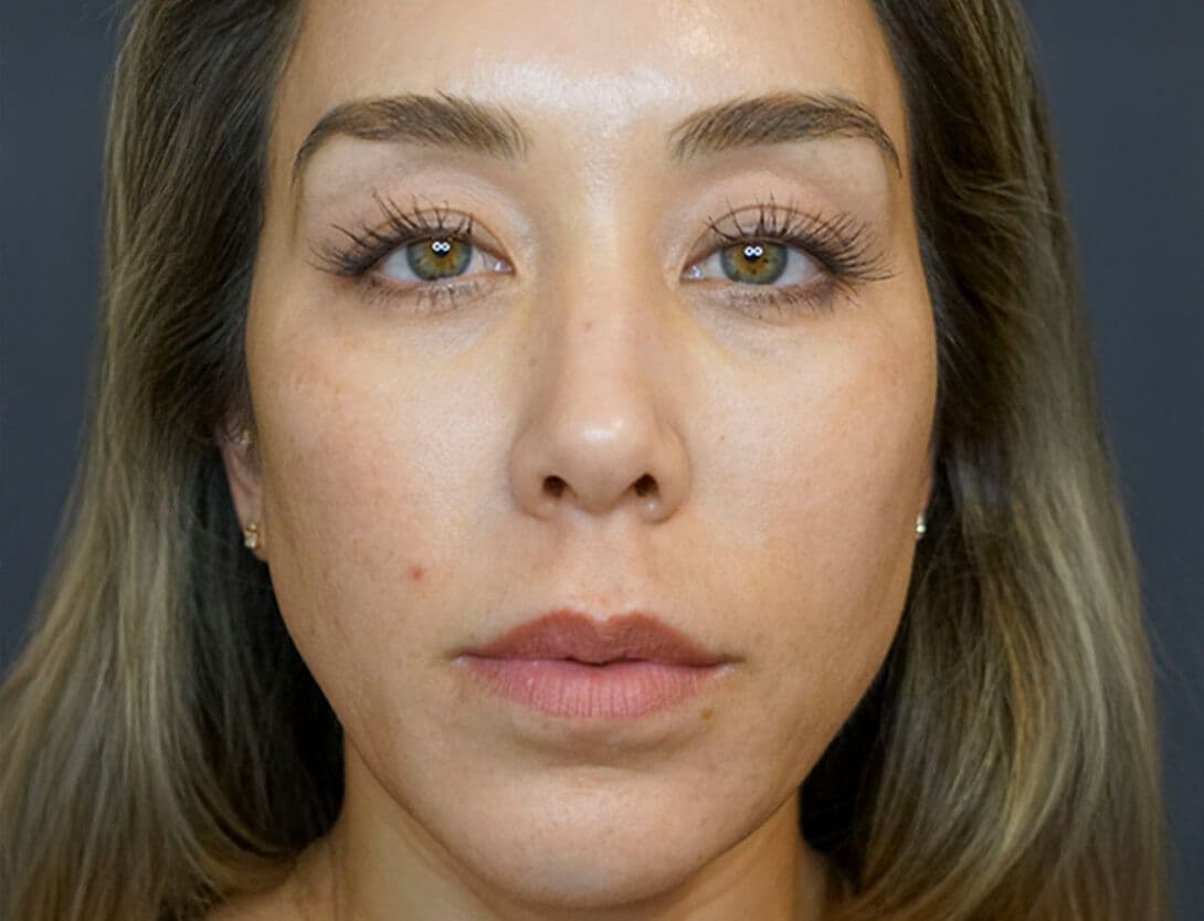 julie_4 syringe_filler_front-Before.jpg