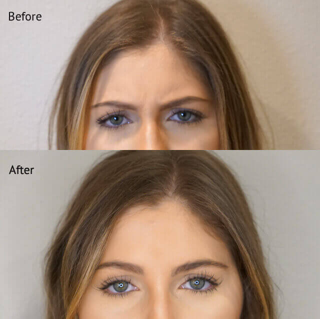 botox-before-and-after-revivemd