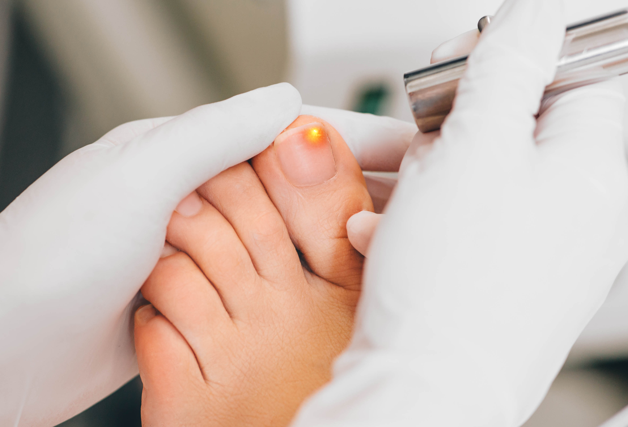 Five Things You Must Know About Laser Nail Fungus Removal | Revive MedSpa In San Diego