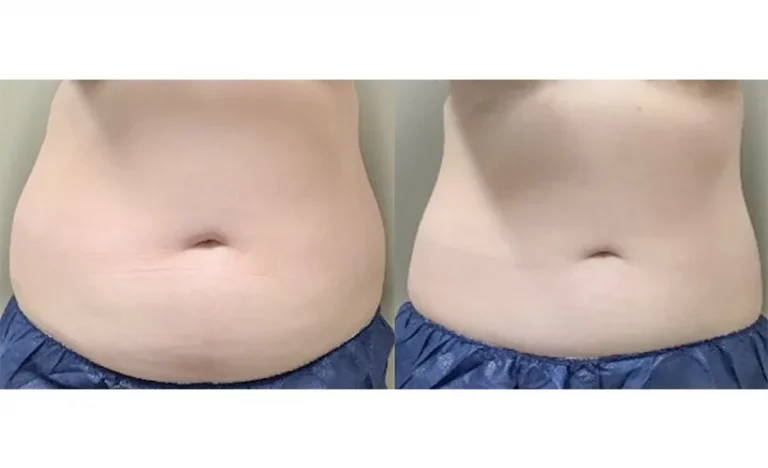 Abdomen Before and After CoolSculpting Elite Photos | Revive Med Spa In San Diego, CA