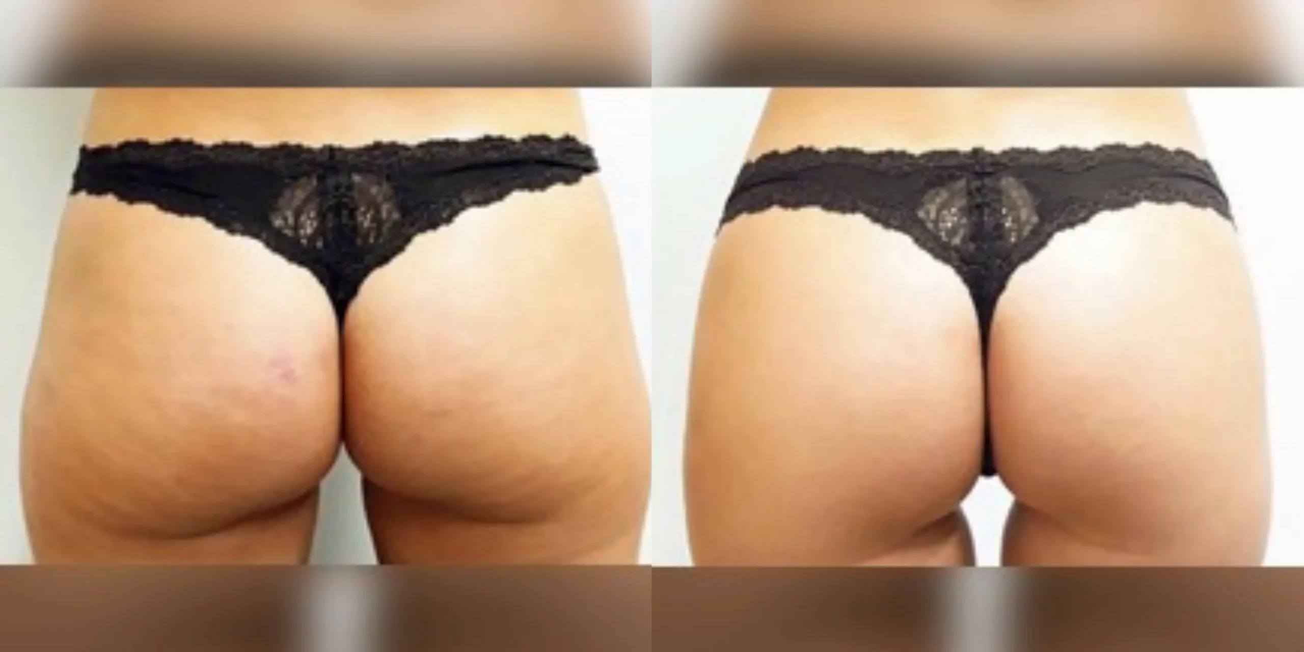 Sculptra Butt Lift Before and After Photos | Revive Med Spa In San Diego, CA