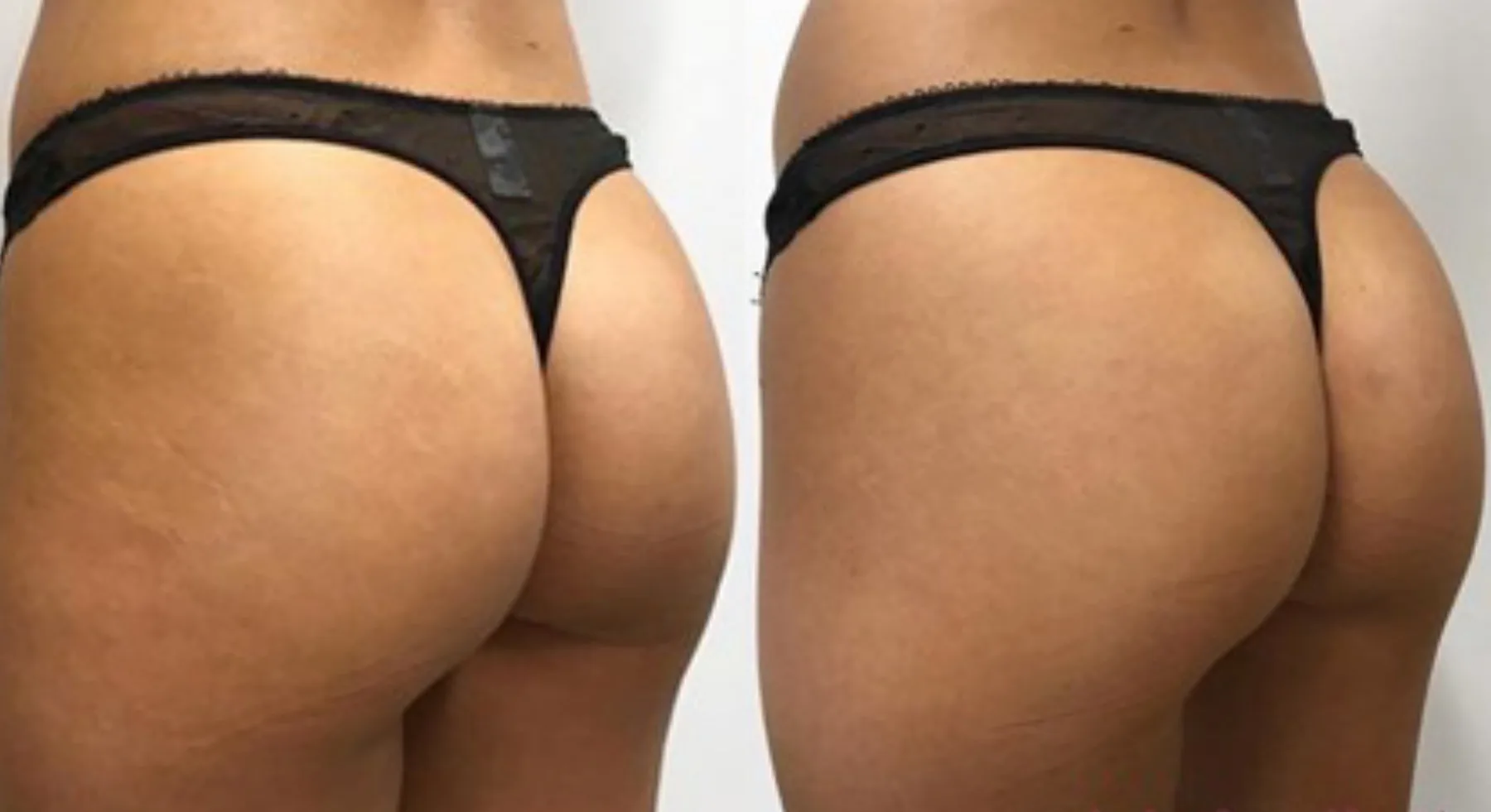 Sculptra Butt Lift Before and After Photos | Revive Med Spa In San Diego, CA