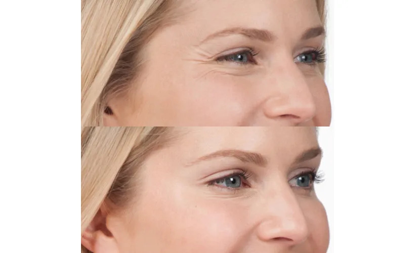 Botox San Diego CA before and after images by Revive Med Spa