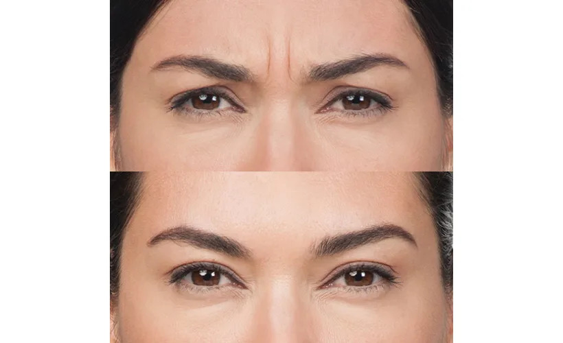 Botox San Diego CA before and after images by Revive Med Spa
