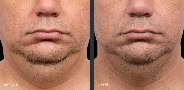 Chin Before and After CoolSculpting Elite Photos | Revive Med Spa In San Diego, CA