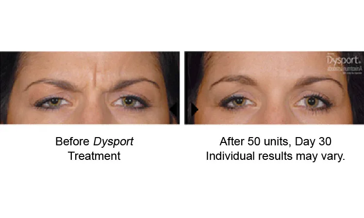 Dysport Before and After Revive Med Spa
