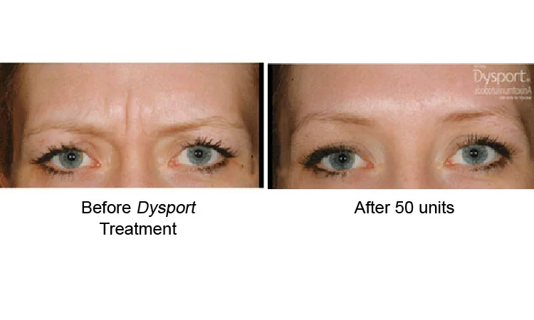 Dysport Before and After Revive Med Spa