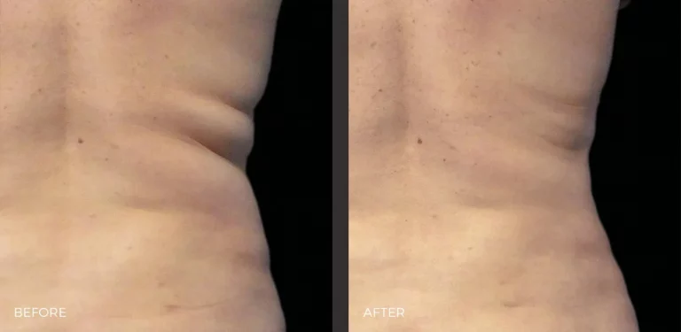 Flank Before and After CoolSculpting Elite Photos | Revive Med Spa In San Diego, CA