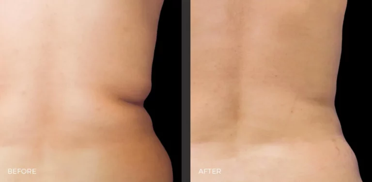 Flank Before and After CoolSculpting Elite Photos | Revive Med Spa In San Diego, CA
