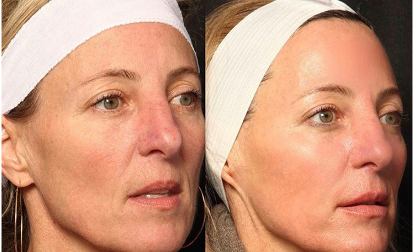 Forever Radiant Duo Laser Skin Services | Revive Med Spa In San Diego, CA