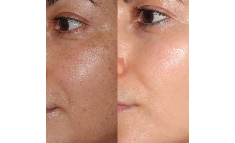 Forever Radiant Duo Laser Skin Services | Revive Med Spa In San Diego, CA