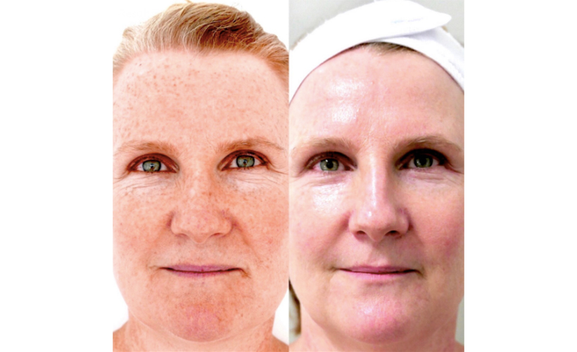 Glow Factor BBL Hero Laser Skin Services | Revive Med Spa In San Diego, CA