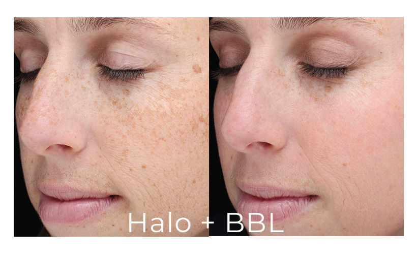Halo Laser Skin Services | Revive Med Spa In San Diego, CA