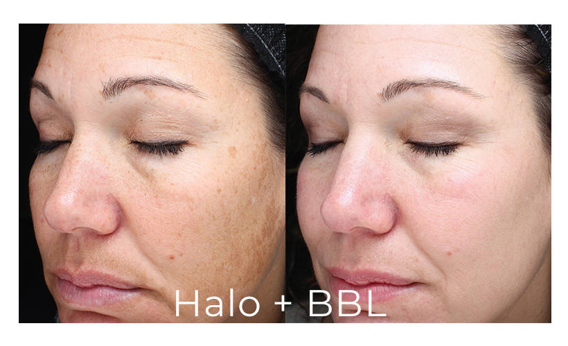 Halo Laser Skin Services | Revive Med Spa In San Diego, CA