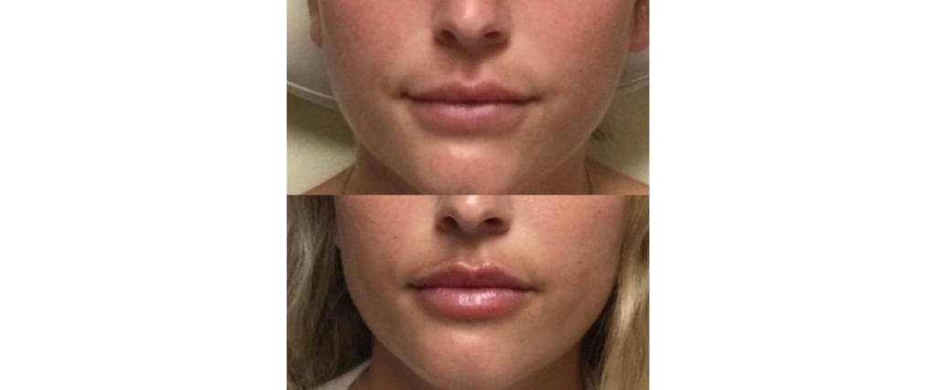 Juvederm Before and After In San Diego, CA | Revive Med Spa