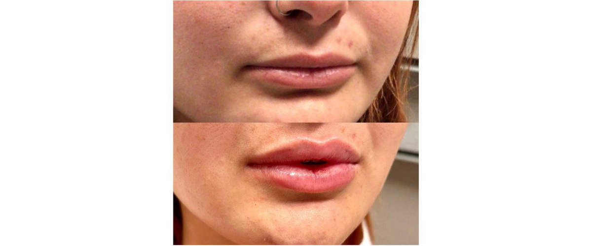 Juvederm Before and After In San Diego, CA | Revive Med Spa