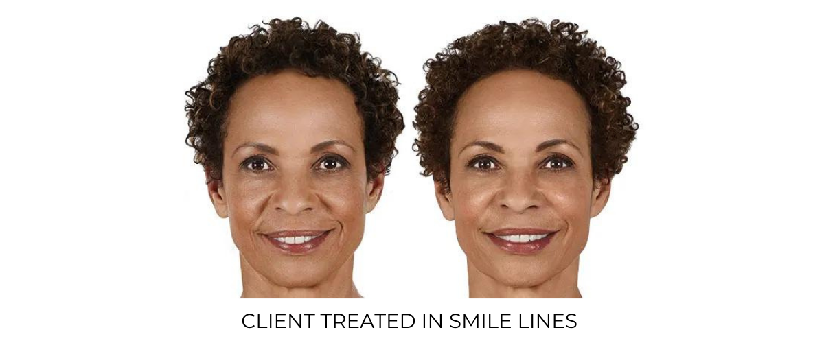 Juvéderm Vollure XC Before and After In San Diego, CA | Revive med spa
