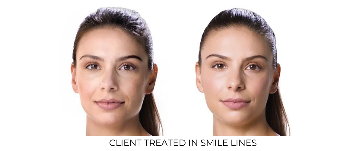 Juvéderm Vollure XC Before and After In San Diego, CA |Revive med spa
