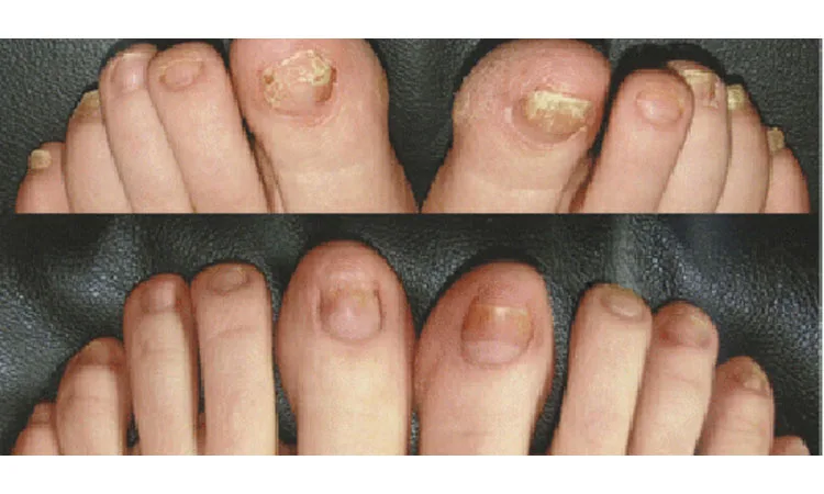 Laser Nail Fungus Removal Before and After Revive Med Spa