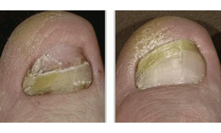 Laser Nail Fungus Removal Before and After Photos | Revive Med Spa In San Diego, CA