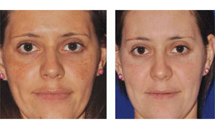 Microneedling before and after treatment image Revive MD in San Diego CA