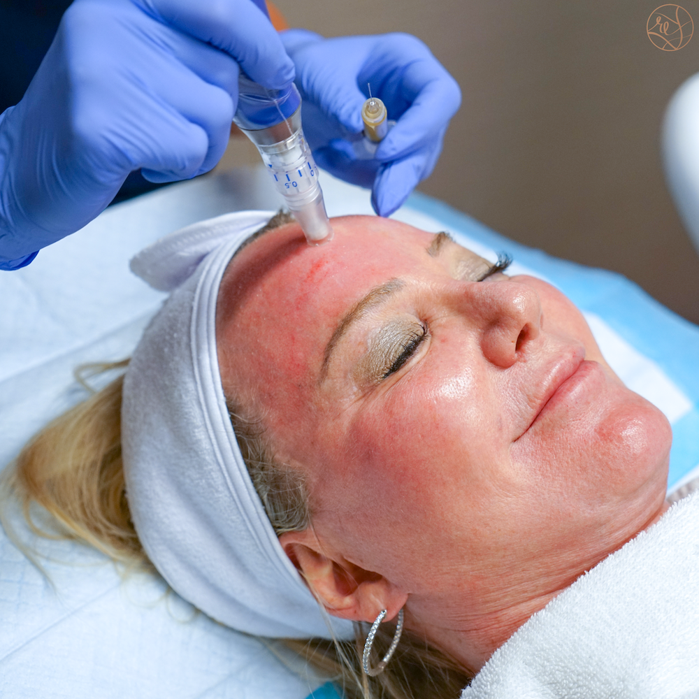 PRP Microneedling & Injections | Revive Med Spa In San Diego, CA