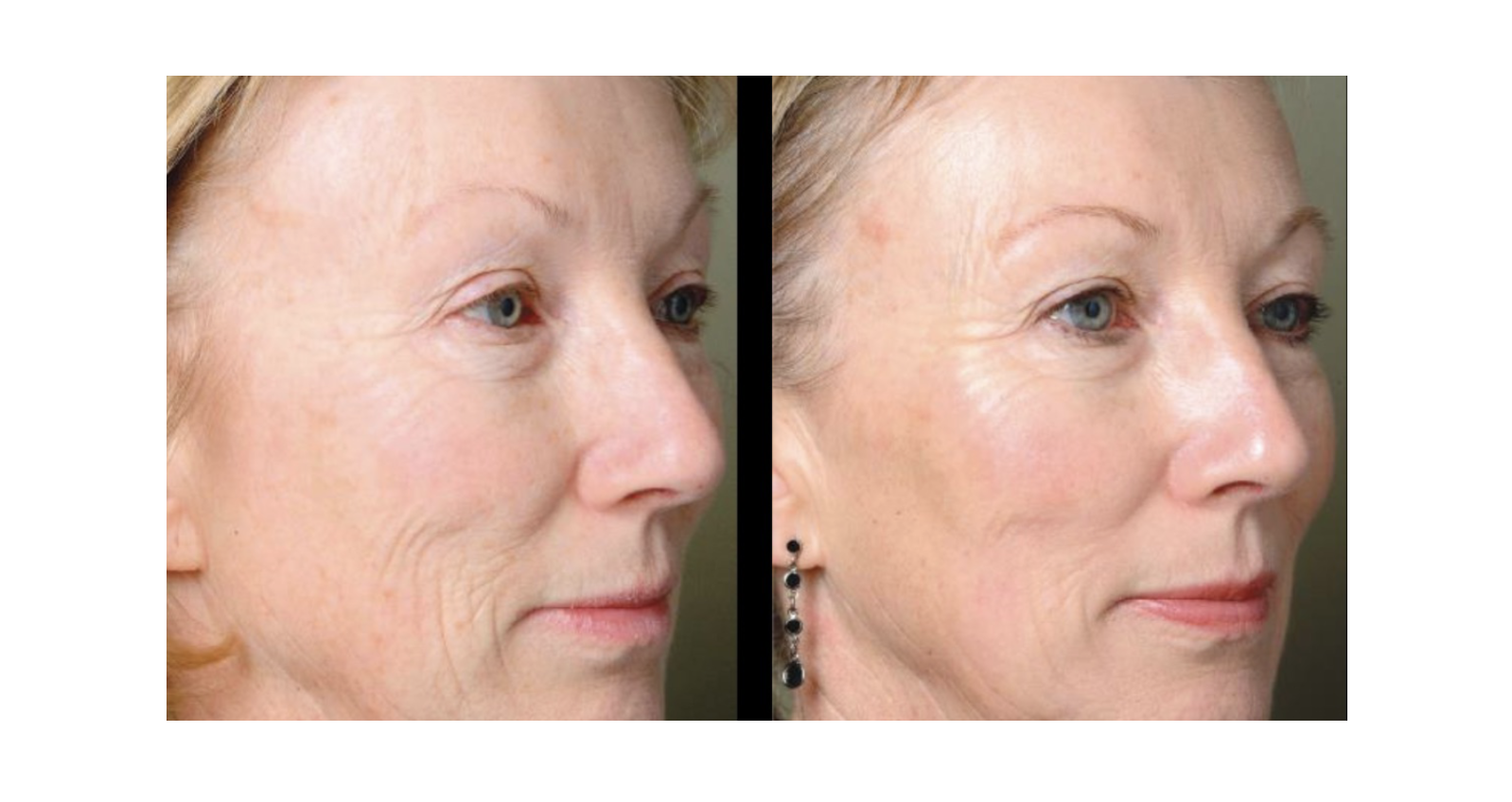 Pro Fractional Laser Skin Services | Revive Med Spa In San Diego, CA
