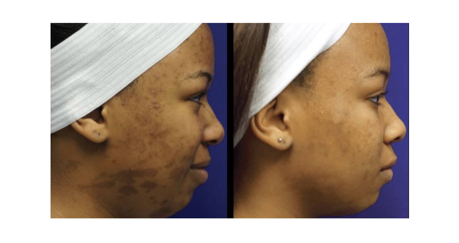 Pro Fractional Laser Skin Services | Revive Med Spa In San Diego, CA