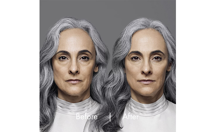 RHA Fillers before and after images revive MD San Diego CA