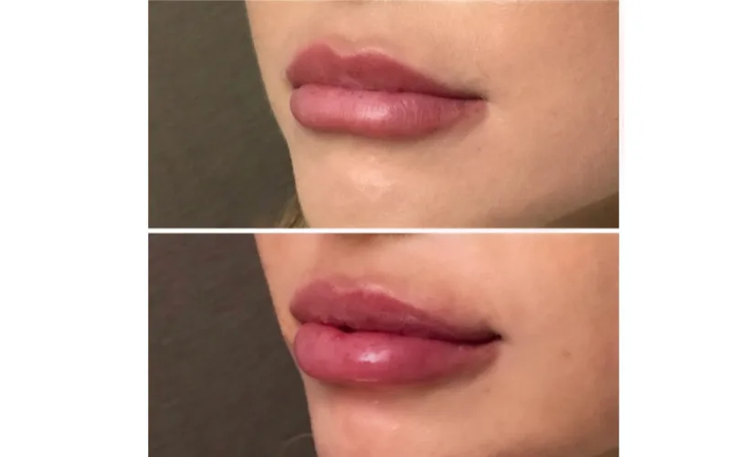 Restylane Kysse Lip fillers before and after revive med spa