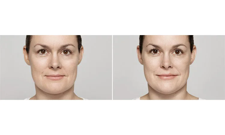 Restylane Lyft Before and After Revive Med Spa