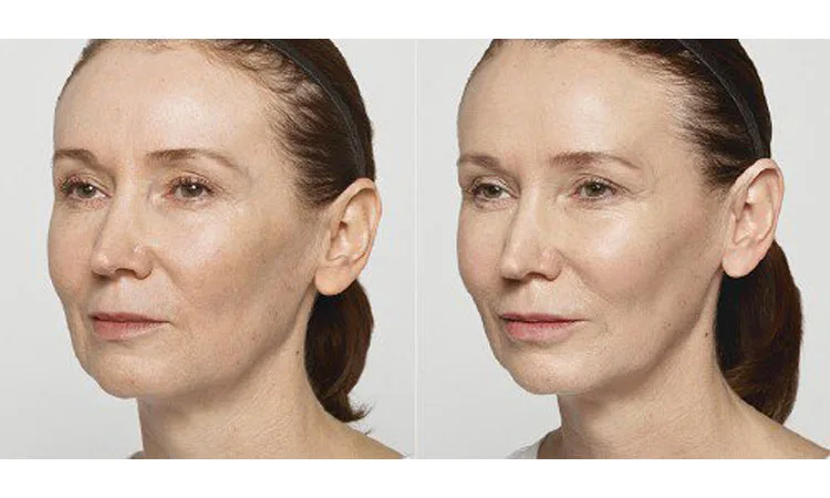 Restylane Lyft Before and After Revive Med Spa