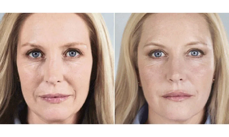 Sculptra for Face Before and After Revive Med Spa