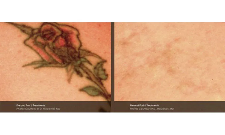 Tattoo Removal Before and after image San Diego CA