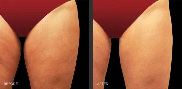 Thighs Before and After CoolSculpting Elite | Revive Med Spa In San Diego, CA